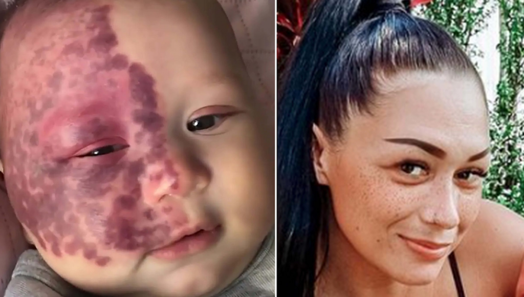 Mother claims she was called a ‘monster’ and faced criticism for choosing to laser off her baby’s facial birthmark; the young woman says she did it to help her child